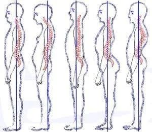 Anterior Pelvic Tilt: What It Is, Why It Happens, and How to Actually Fix It
