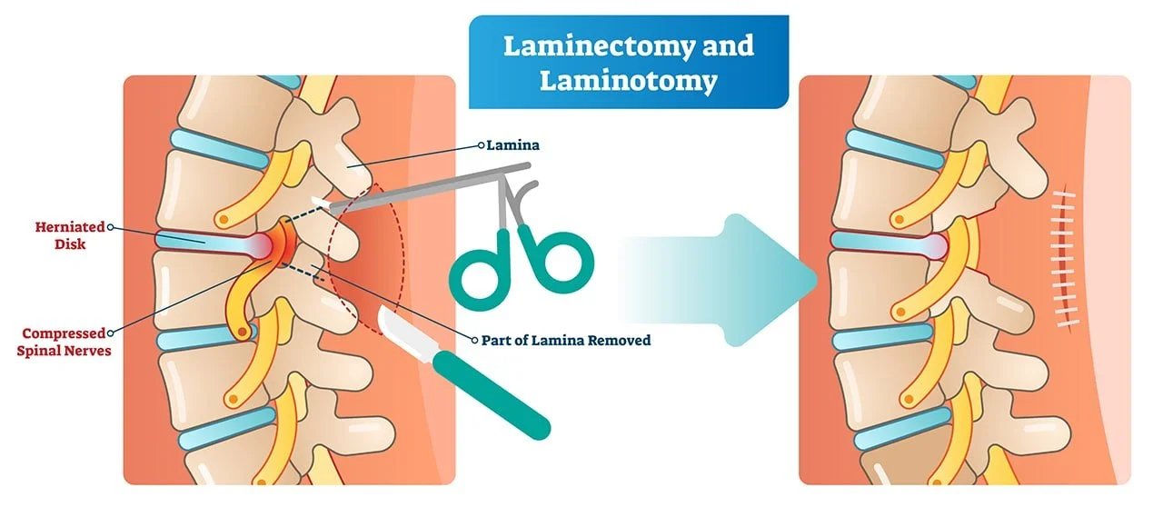 spinal decompression surgery