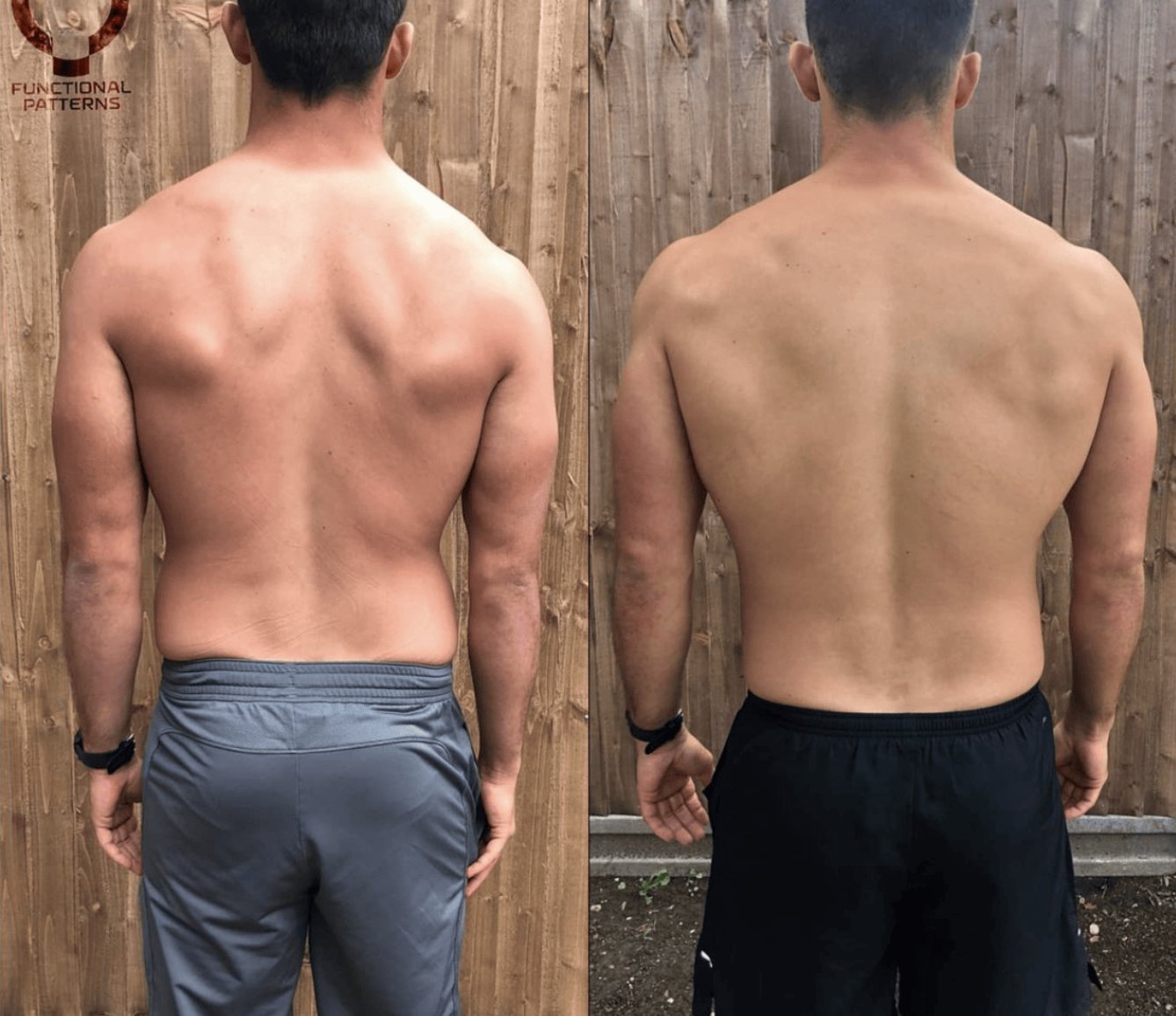 7 Effective Home Remedies for Shoulder Pain Today (And Why Most Don’t Last)