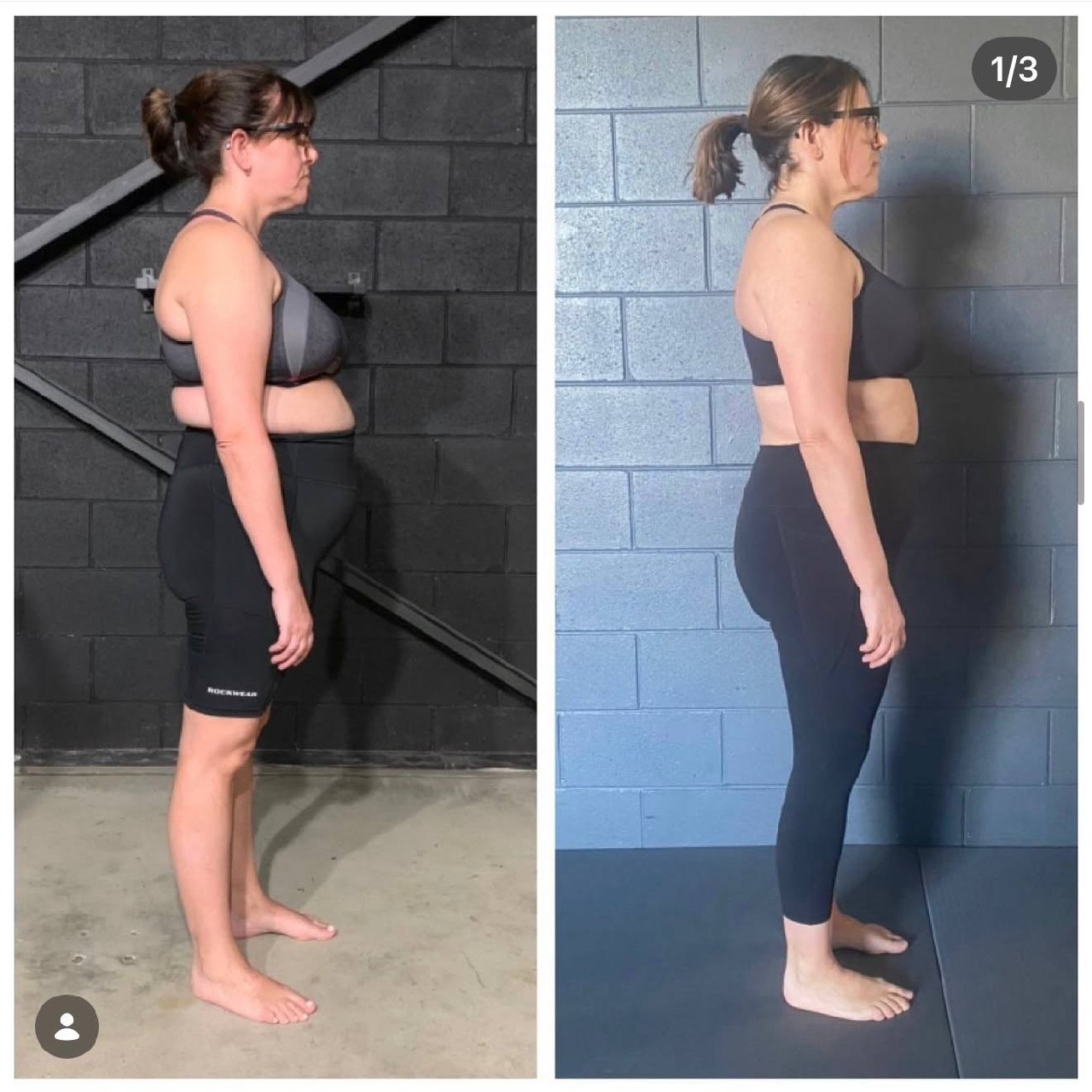 Anterior Pelvic Tilt Fix — What Actually Works — image 1