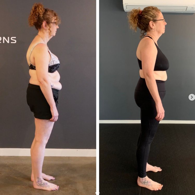 Buffalo Hump vs Dowager’s Hump: What’s the Difference?