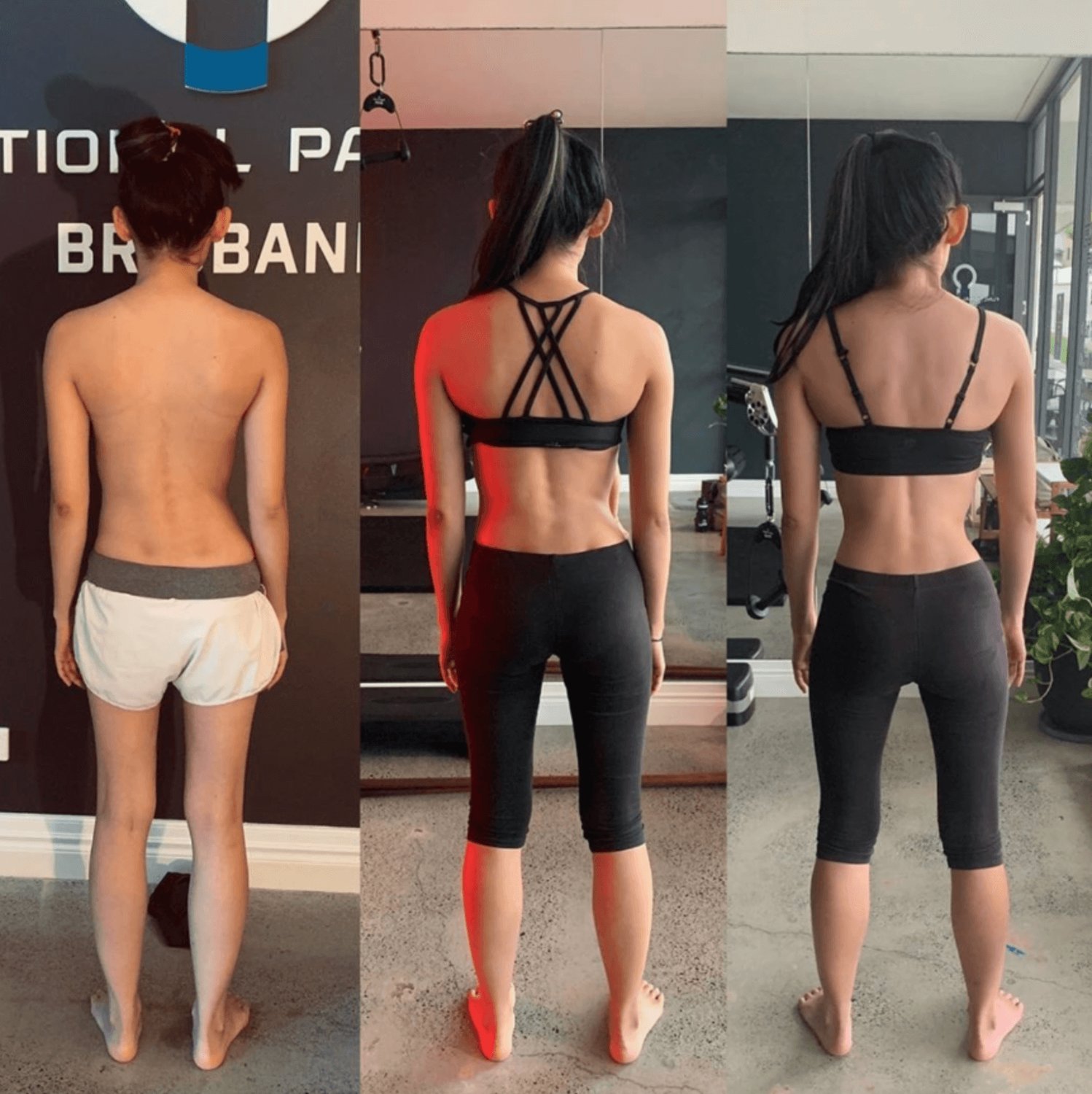 Scoliosis Fixed using Functional Patterns