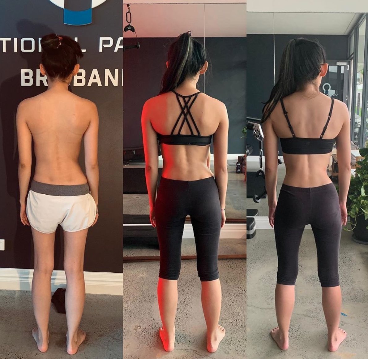 Can You Fix Scoliosis Naturally With A Scoliosis Specialist?