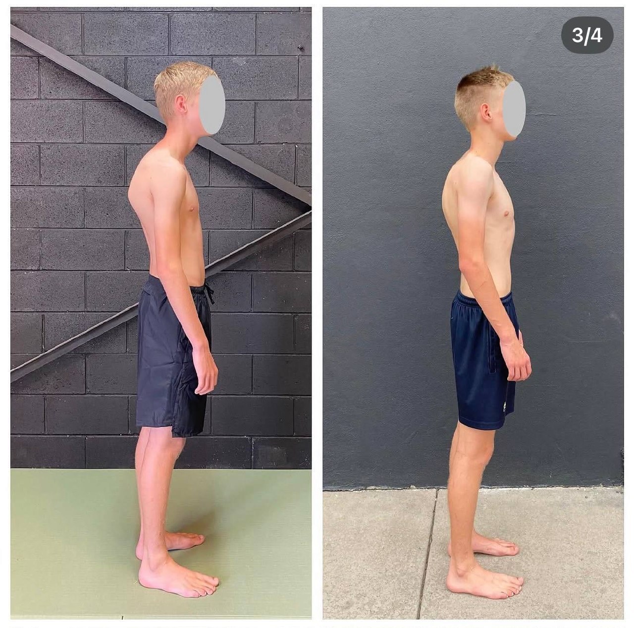 Double Jointed Shoulders: What Hypermobility Really Means for Your Body — image 2