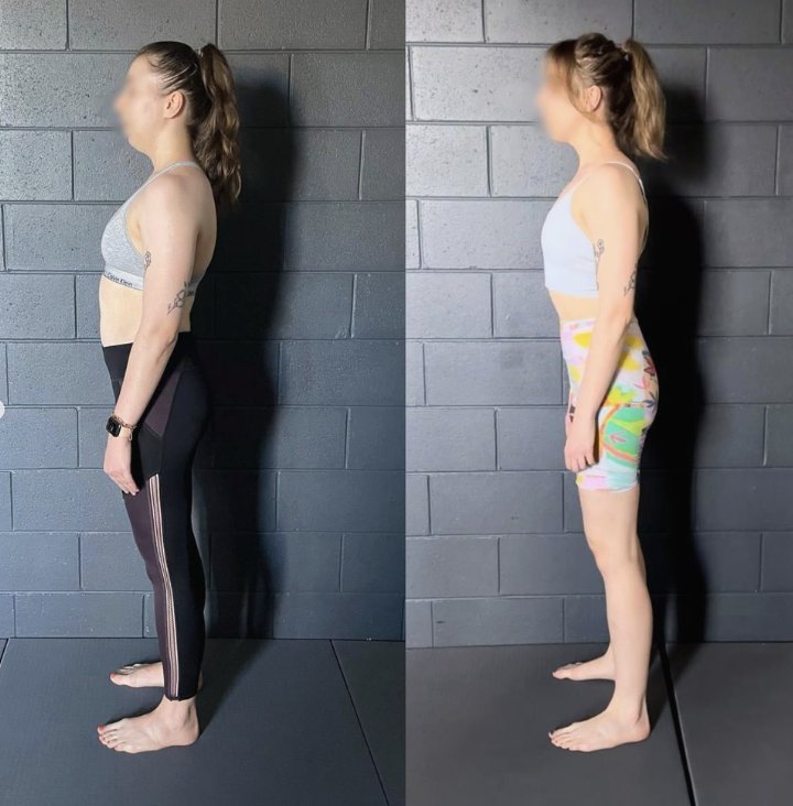Dowager’s Hump Exercises: Why They Rarely Fix the Problem