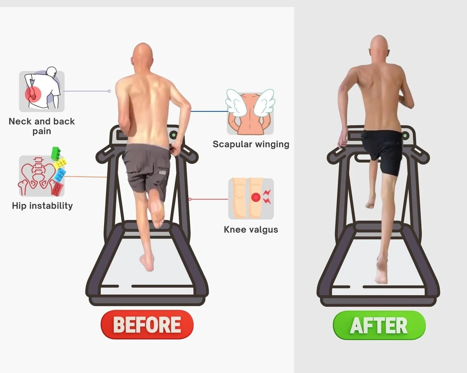How to fix scoliosis naturally 3 — Exercises For Hyperextended Knees: A Guide To Strength