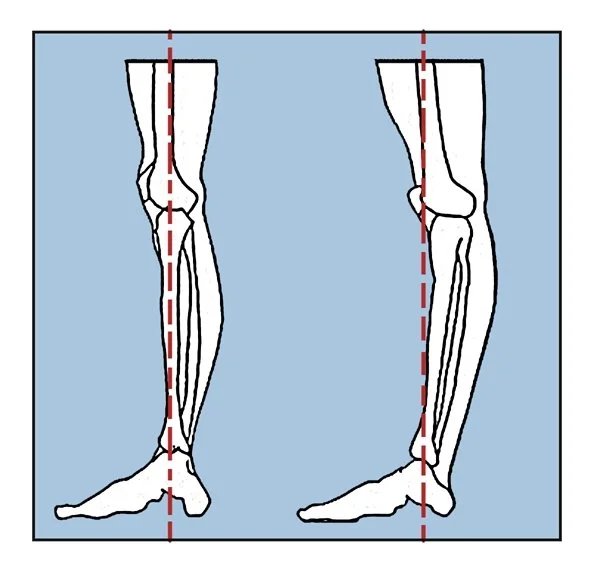 Exercises For Hyperextended Knees