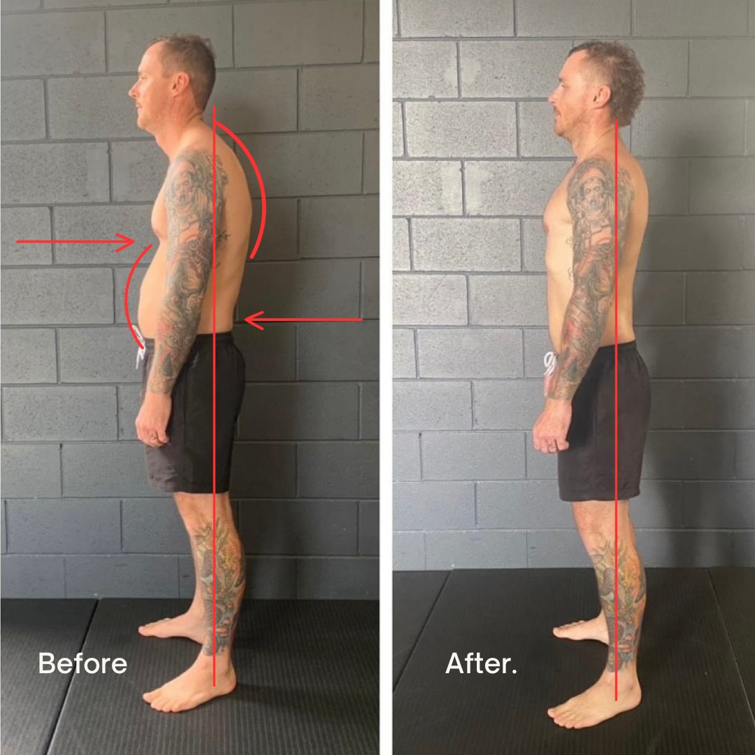 Beige minimalist skincare before and after instagr — How to Fix a Kyphosis and Lordosis Naturally
