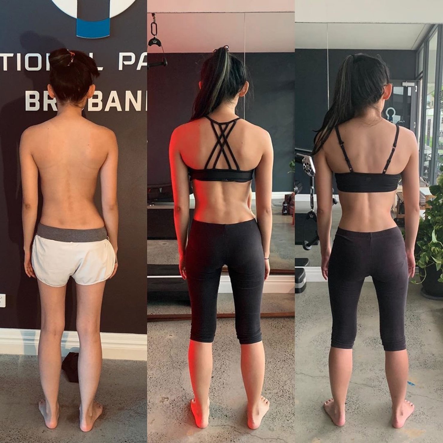 How To Fix Scoliosis Naturally Using Intra Abdominal Pressure