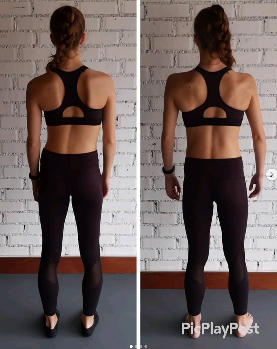 How To Fix Scoliosis Naturally Using Intra Abdominal Pressure