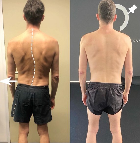 Screen shot 2022 12 13 at 11 13 09 am — How To Fix Scoliosis Naturally Using Intra Abdominal Pressure