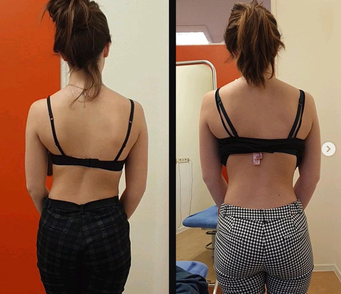 How To Fix Scoliosis: A Functional Approach 