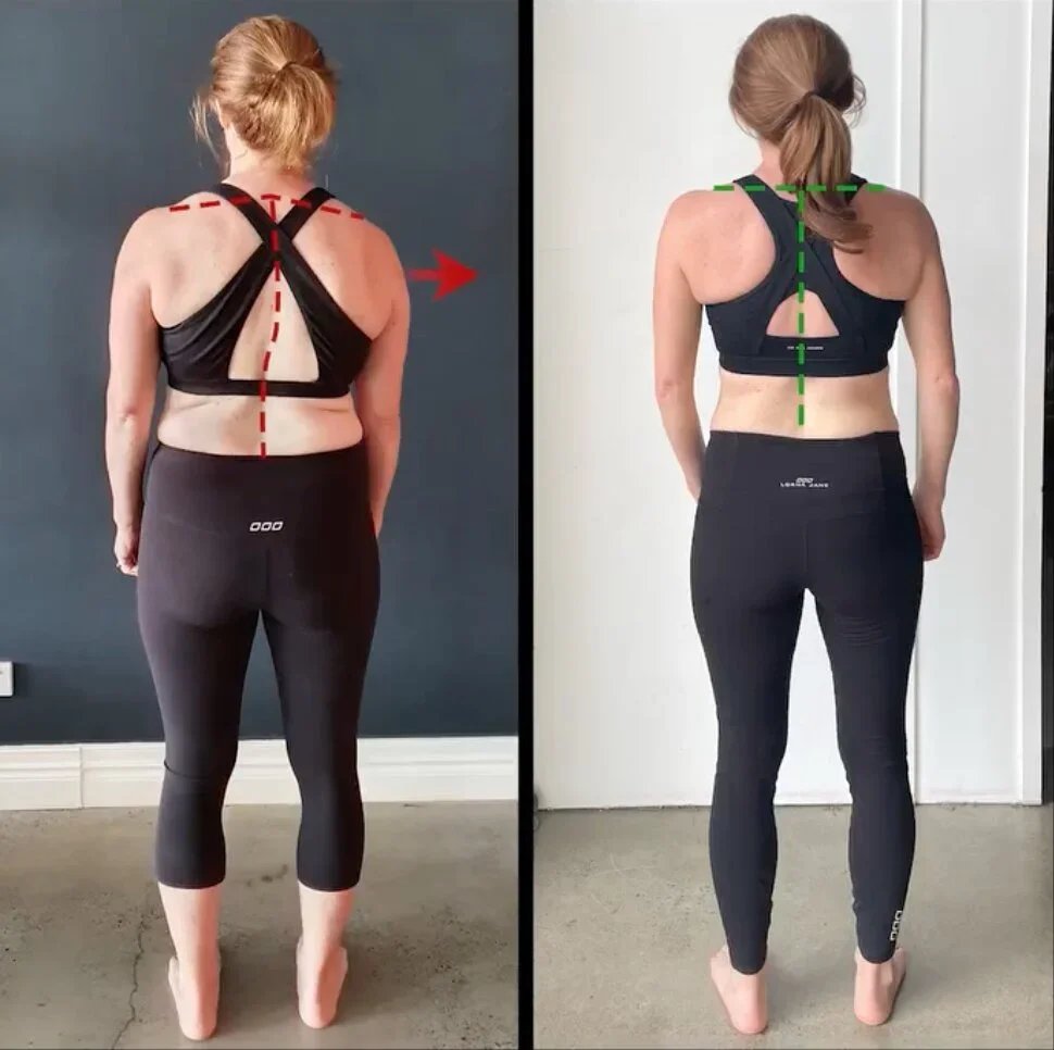 Can scoliosis be cured 1 — How to Heal a Bulging Disc Naturally — Functional Patterns Brisbane