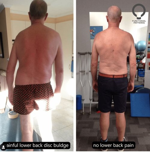 Learn why pain beneath the shoulder blade keeps re — How to Heal a Bulging Disc Naturally — Functional Patterns Brisbane