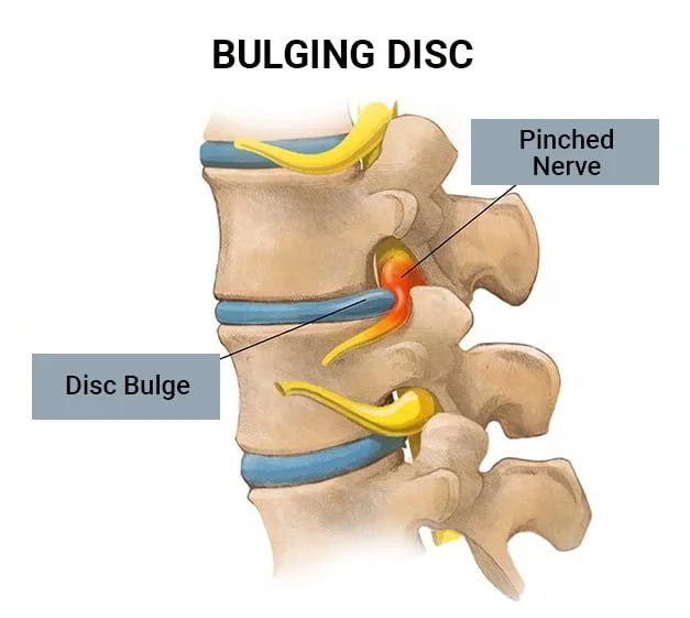 How to Heal a Bulging Disc Naturally — Functional Patterns Brisbane