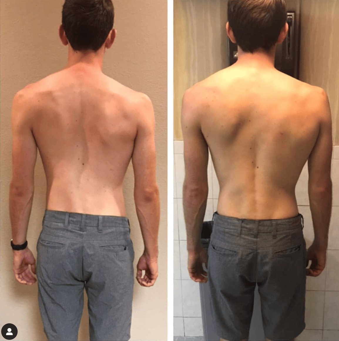 Exercises for winged scapula1 — Is Functional Patterns The Same As Scoliosis Physiotherapy?