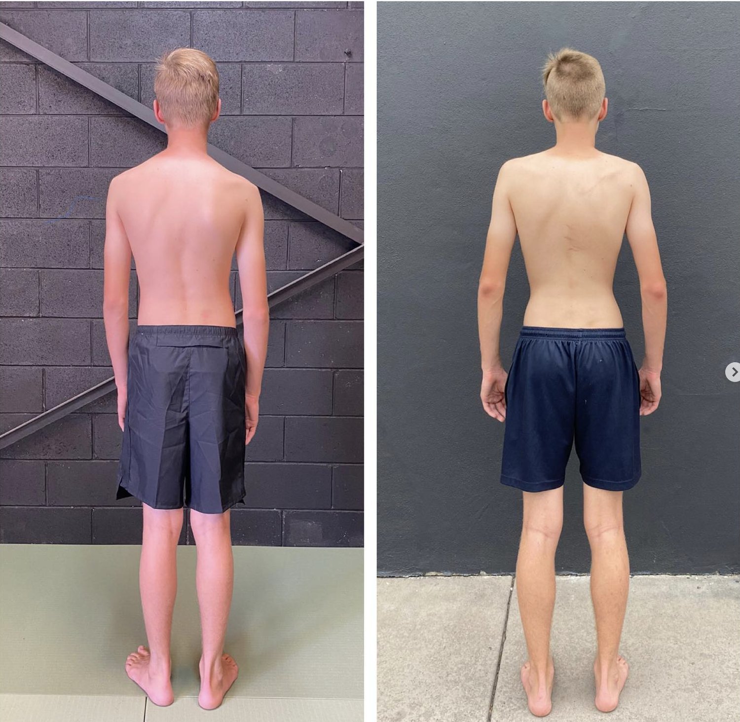 Is Functional Patterns The Same As Scoliosis Physiotherapy?