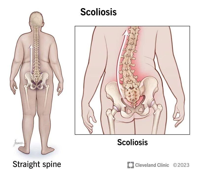 Is Scoliosis Hereditary? What Genetics Can — and Can’t — Explain