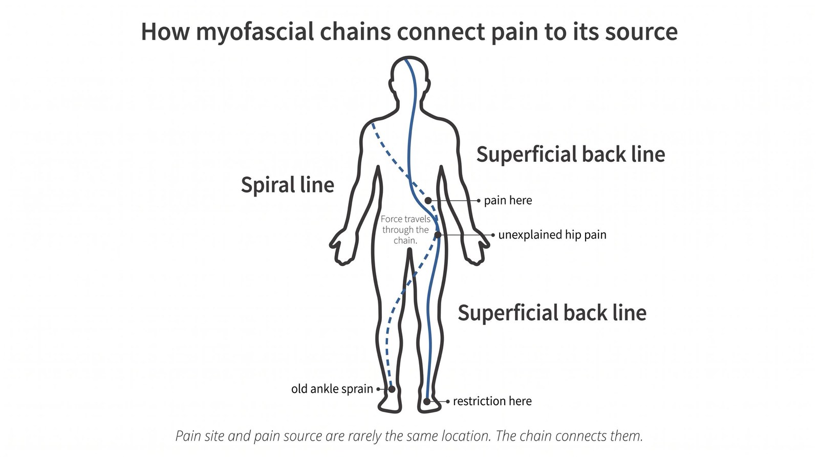 Myofascial Chains: Why Your Hip Pain Might Be Coming From Your Foot
