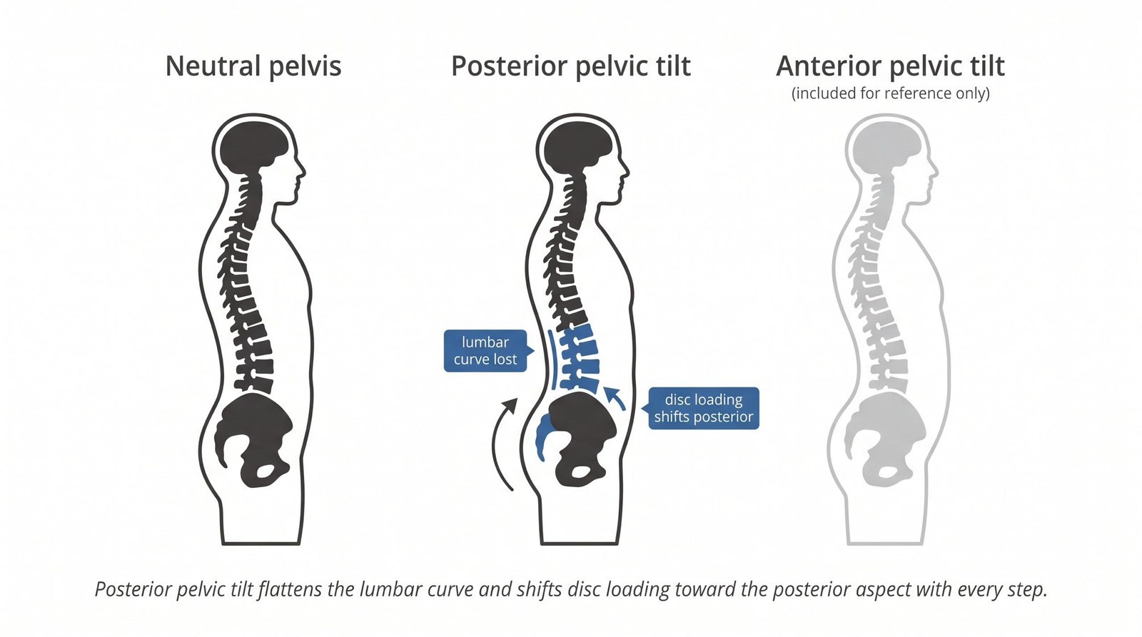 Posterior Pelvic Tilt: Is This Why You're In Pain?
