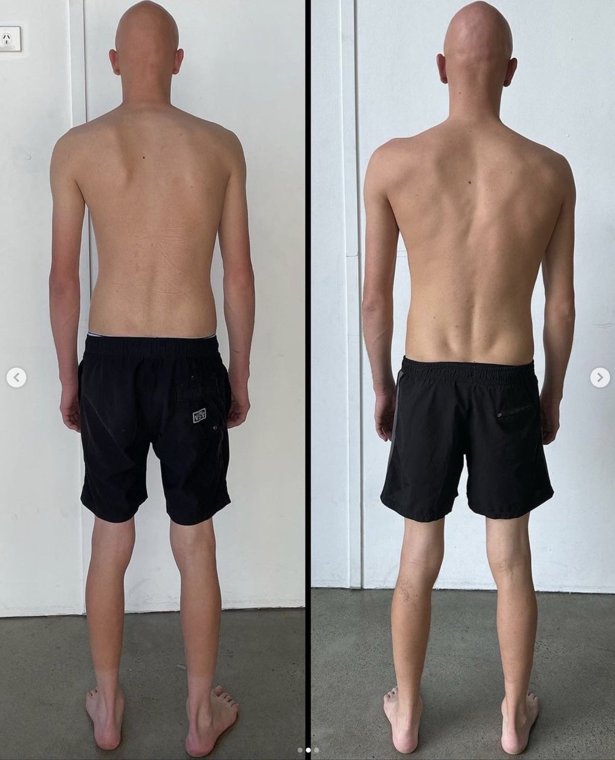 Functional Patterns Scoliosis Result