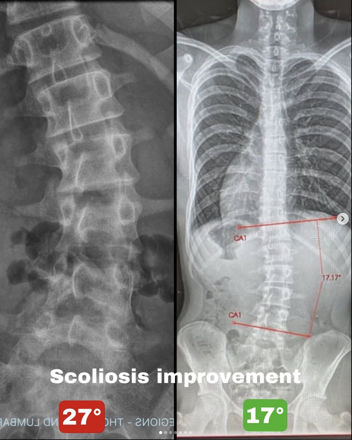scoliosis non surgical correction Brisbane