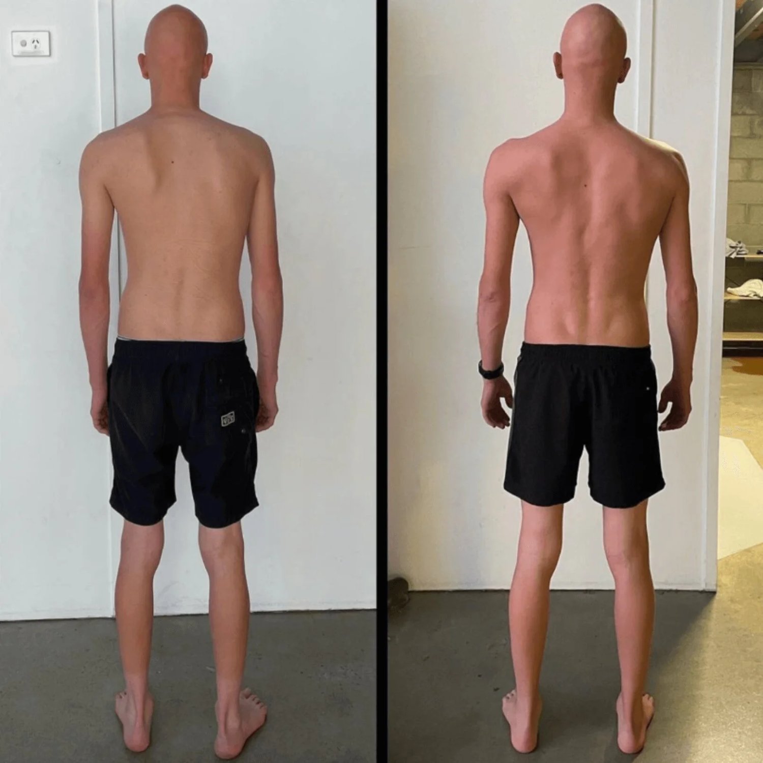 Scoliosis physiotherapy brisbane 2 — Scoliosis Correction Brisbane: Why Intra-Abdominal Pressure Changes Everything
