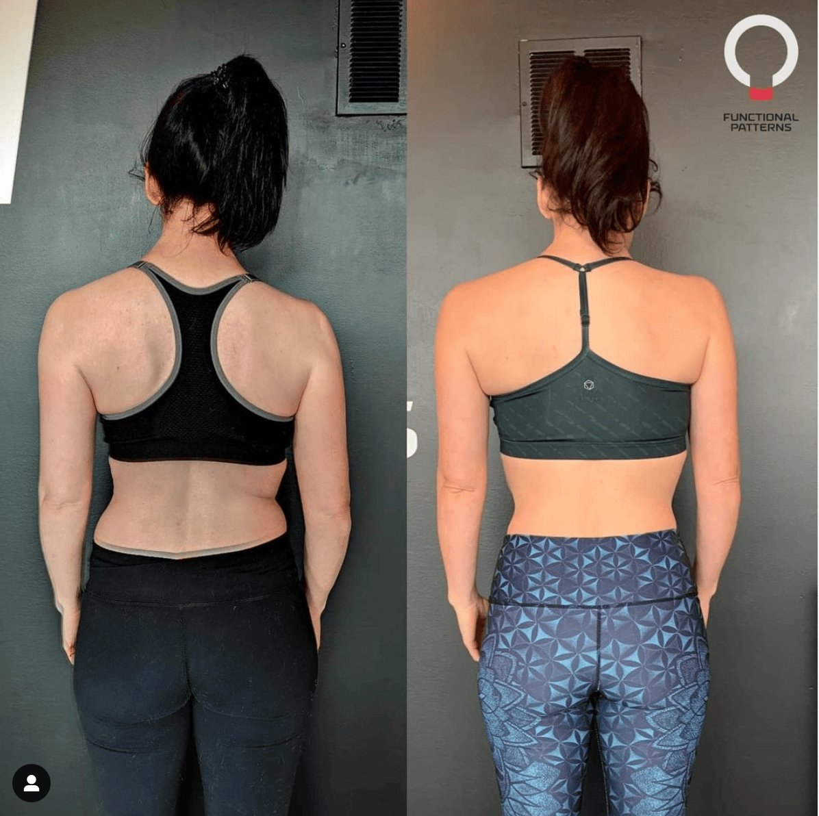 Scoliosis Workouts: Move Better, Without Compensations