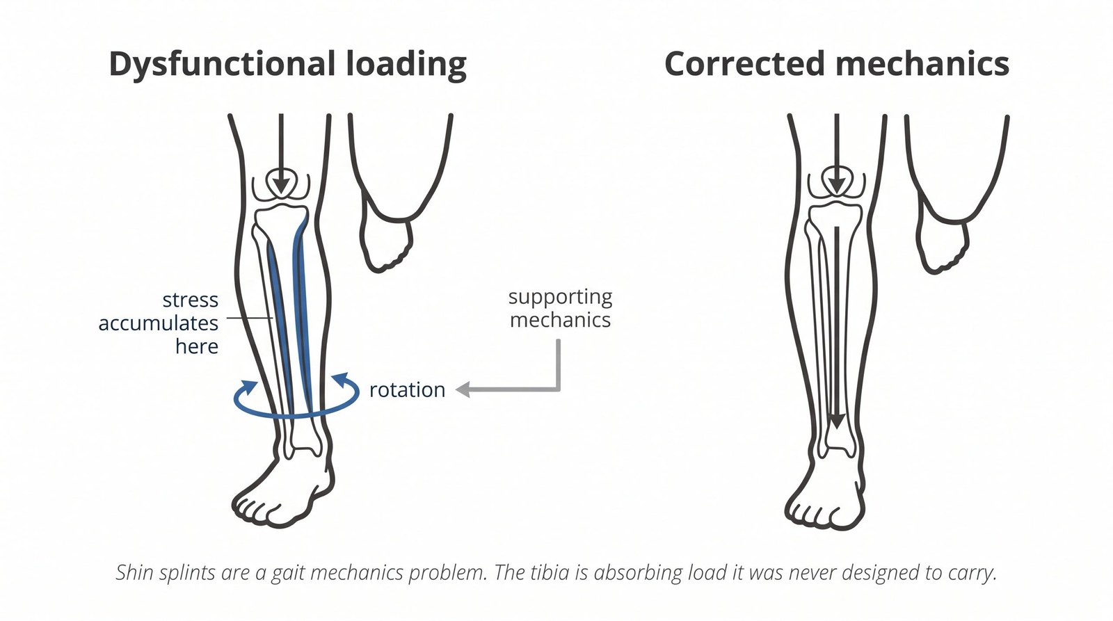 Shin Splints Won't Go Away: Here's the Root Cause