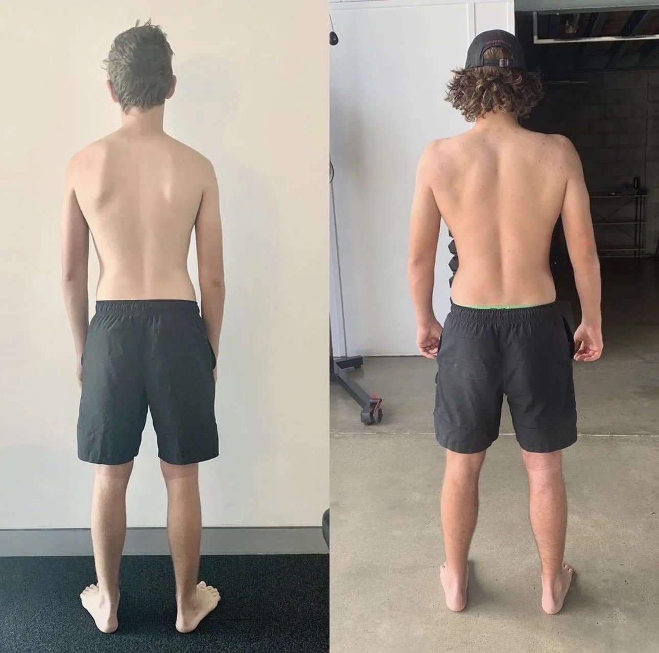 Subscapularis tendinosis, the actual cause and solution