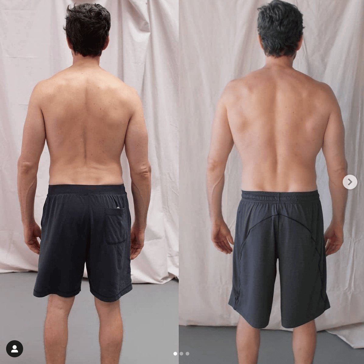 Subscapularis tendinosis, the actual cause and solution
