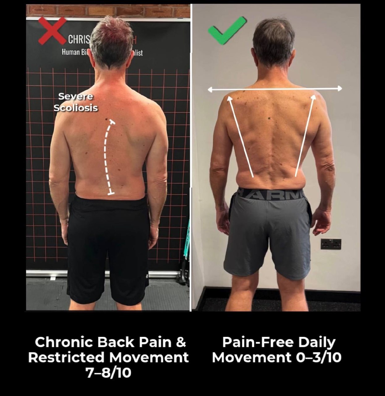 Tech Neck — What Your Phone Is Actually Doing to Your Spine
