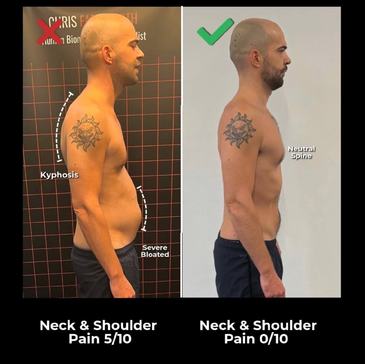 Tech Neck — What Your Phone Is Actually Doing to Your Spine — image 2