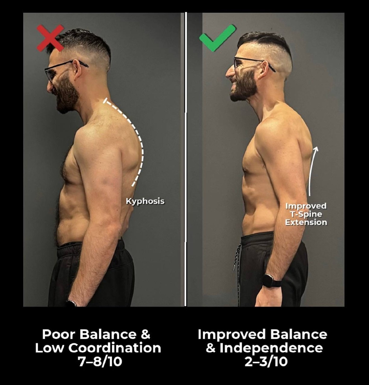 Tech Neck — What Your Phone Is Actually Doing to Your Spine — image 3