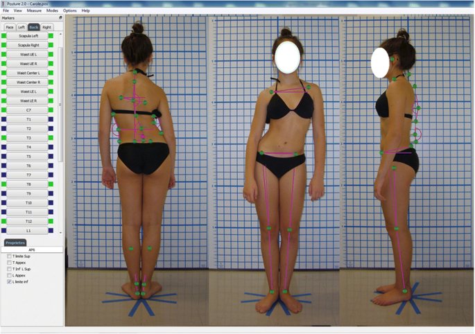 Top Assessment Tool for Chronic Pain & Posture Correction