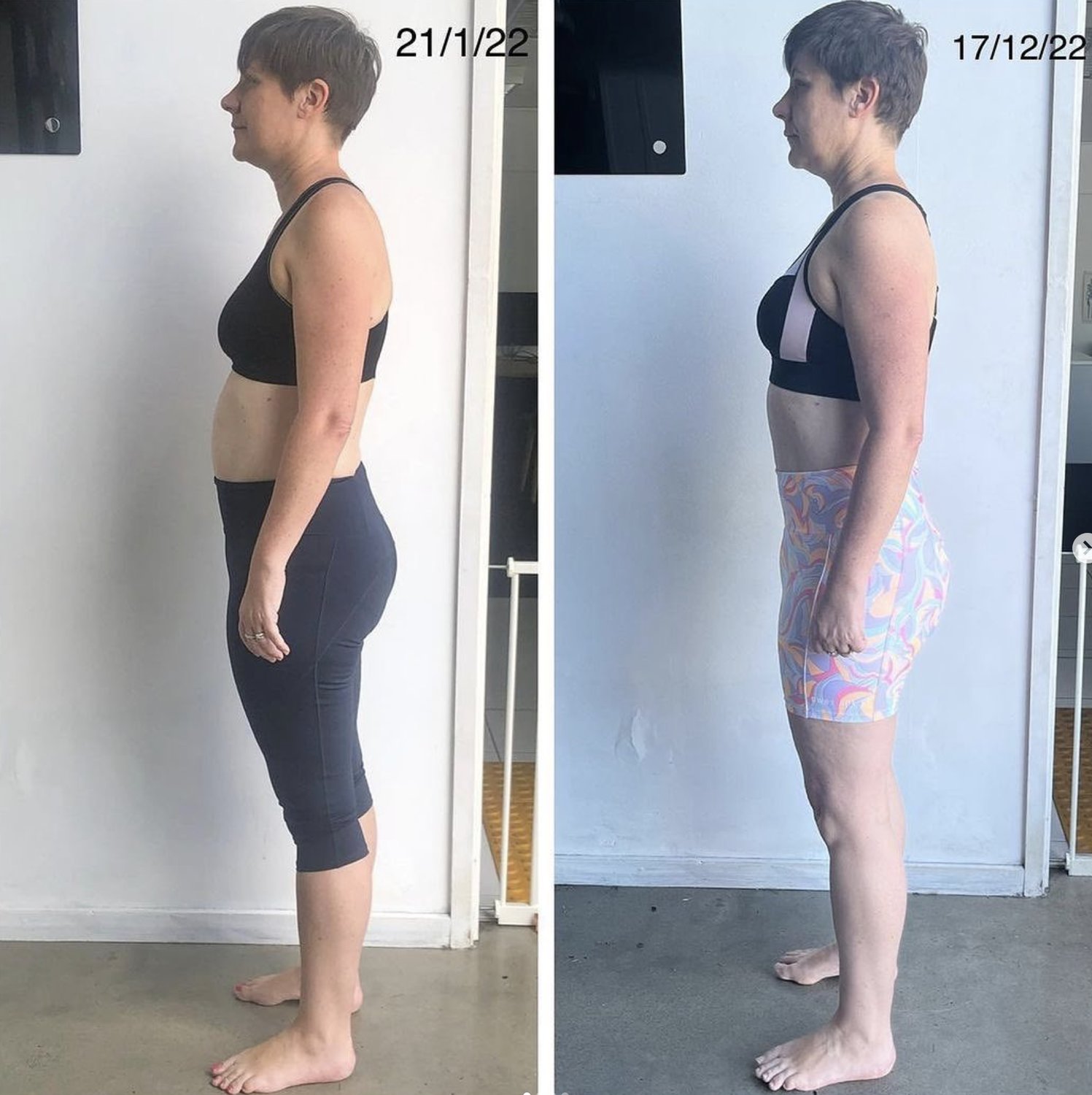 Knee brace for hyperextended knee — Why A Knee Hyperextension Brace Is Not The Answer