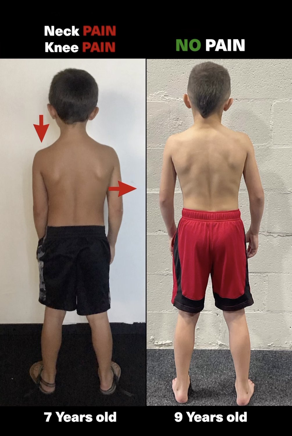 Why Kids & Teenagers Should Get A Gait/Running Analysis 