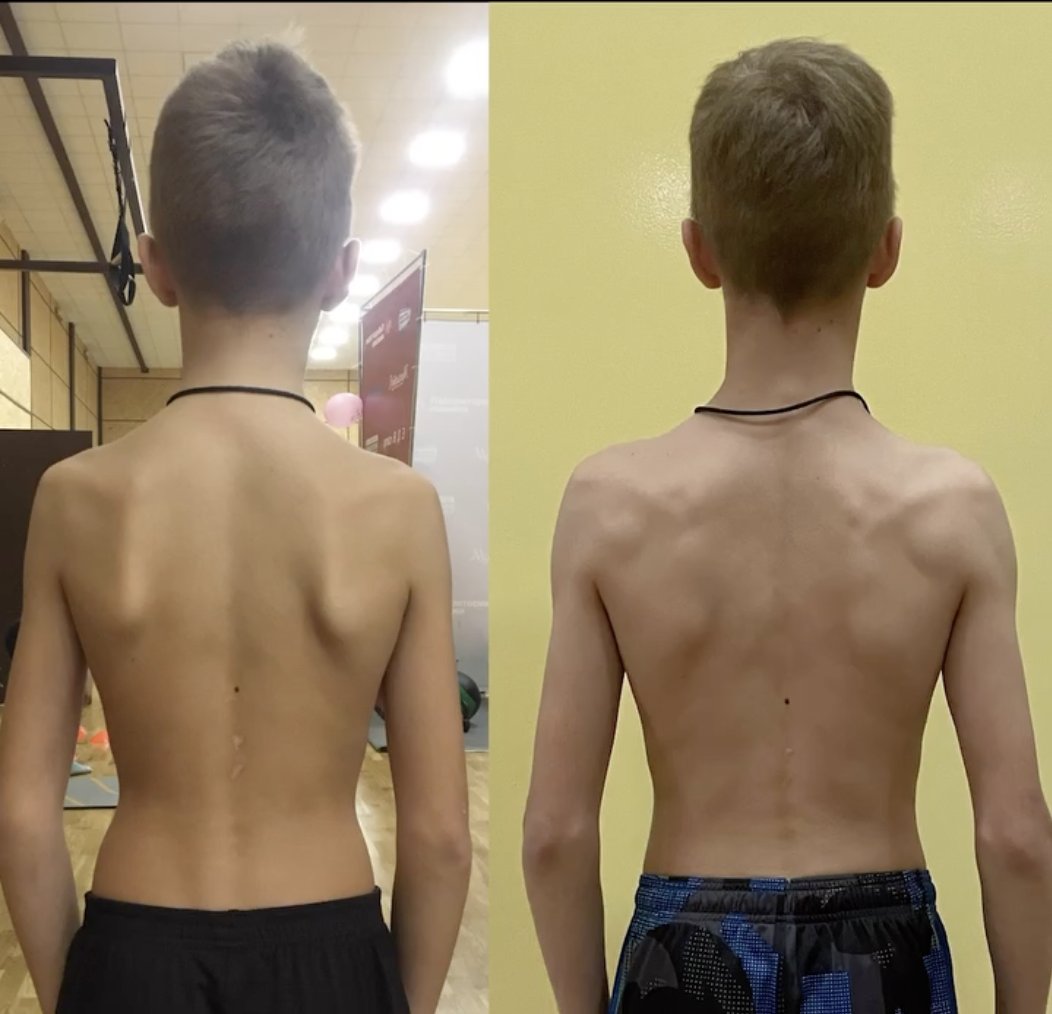 Why Kids & Teenagers Should Get A Gait/Running Analysis