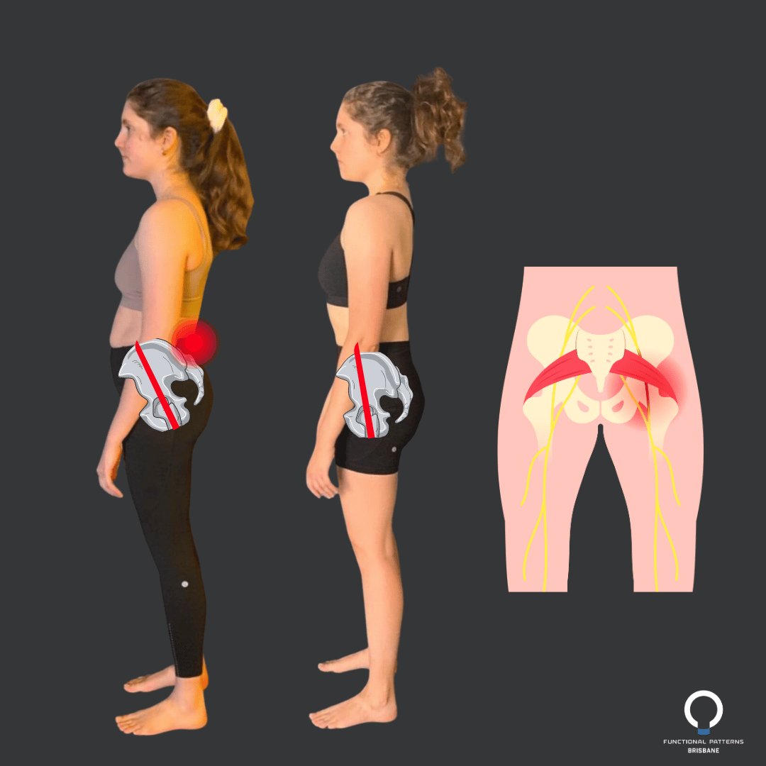 Why You Get Sciatica - The REAL Reason, & How To Stop It.