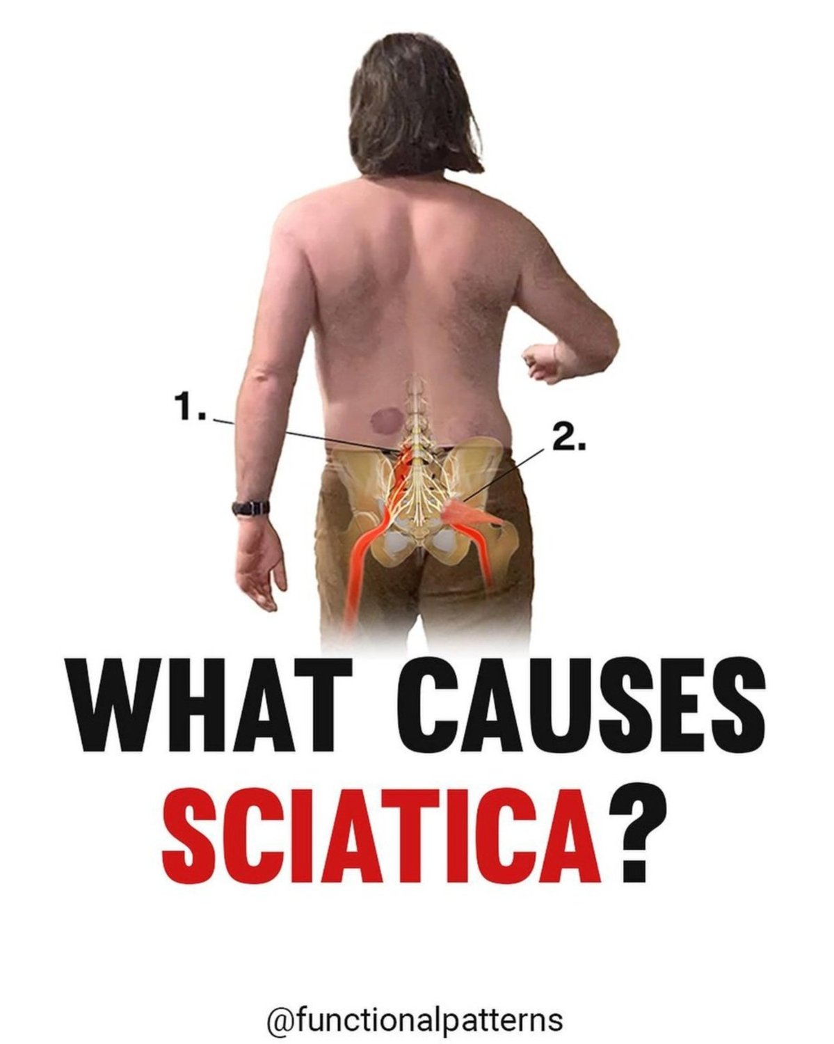 Why You Get Sciatica - The REAL Reason, & How To Stop It.