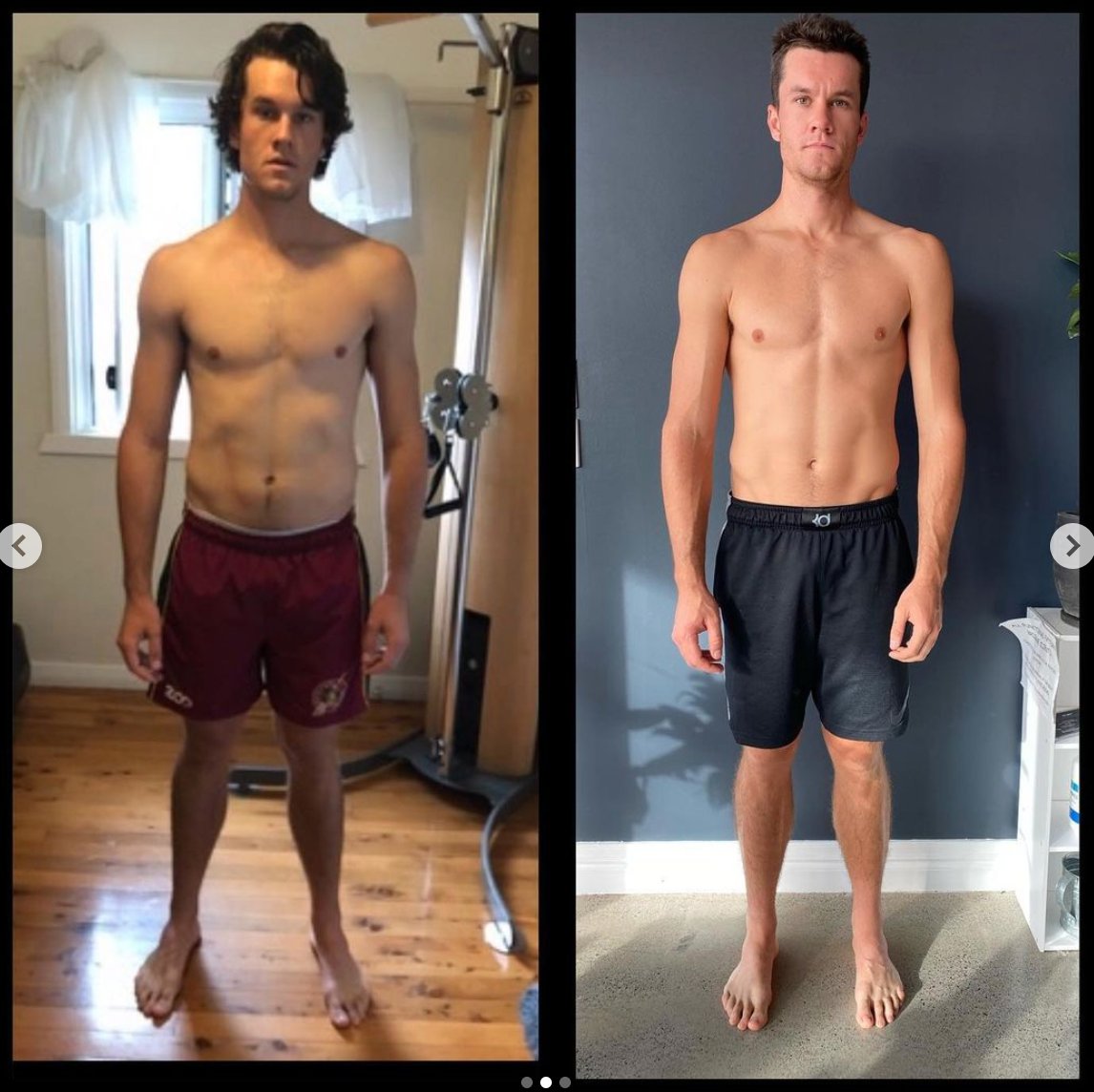 Rib Flare improved through diet and functional patterns exercise.