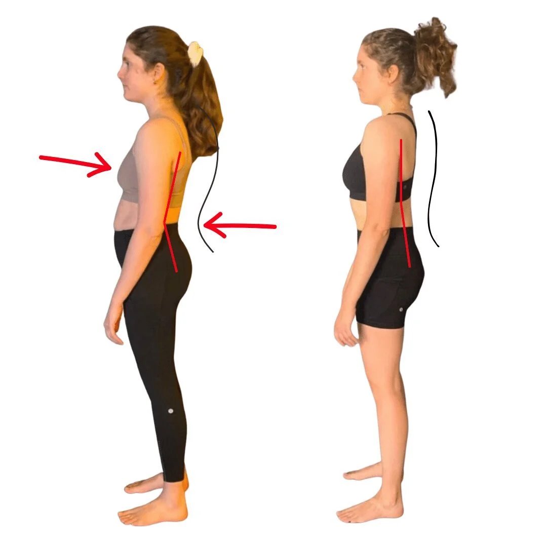 Hunchback posture corrector — Why Your Rounded Shoulders Keep Coming Back – And What to Do Instead