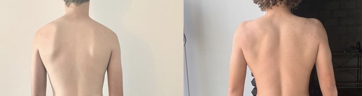 Why Your Scapulars Stick Out (Winged Scapulars): The Thoracic Spine