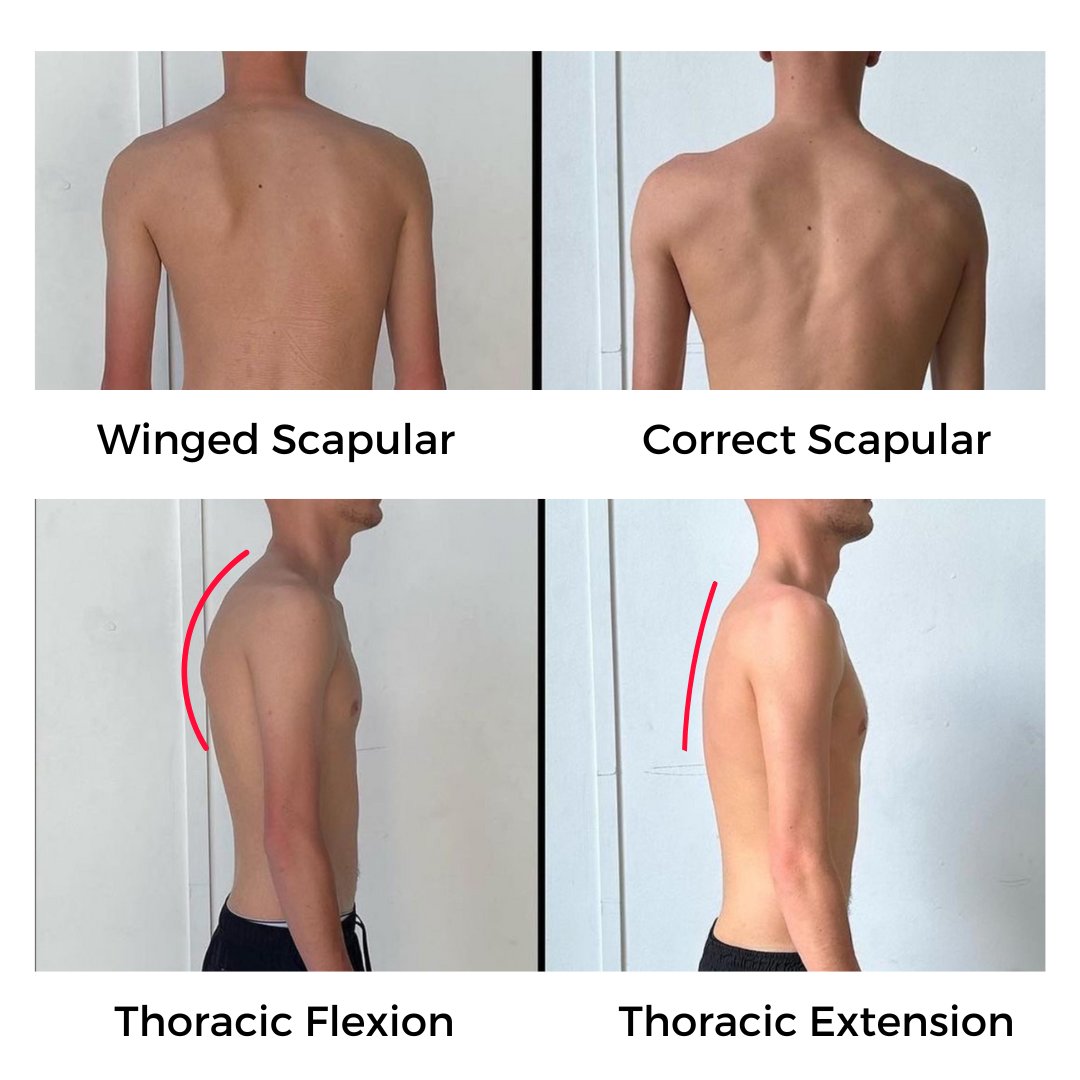 Why Your Scapulars Stick Out (Winged Scapulars): The Thoracic Spine