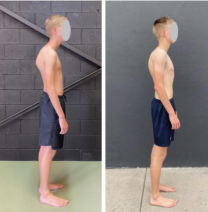 hunchback posture treatment exercises — Functional Patterns Brisbane