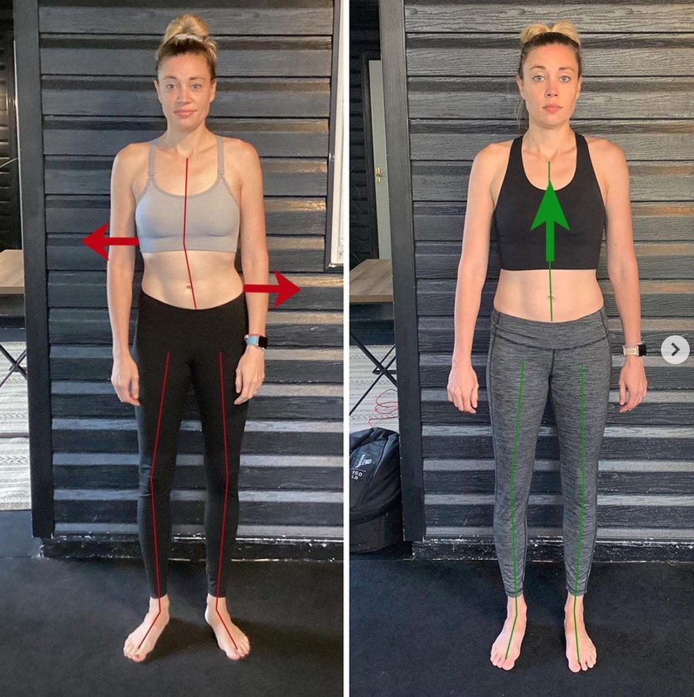 Some Scoliosis Before And Afters From Functional Patterns... — Functional Patterns Brisbane