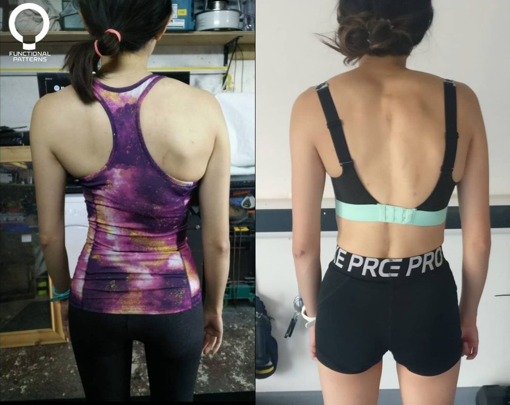 Some Scoliosis Before And Afters From Functional Patterns... — Functional Patterns Brisbane