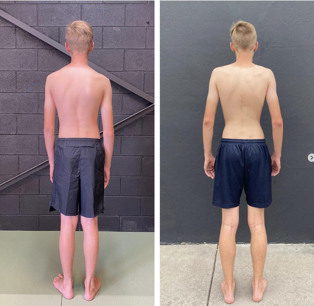 scoliosis physio brisbane — Functional Patterns Brisbane