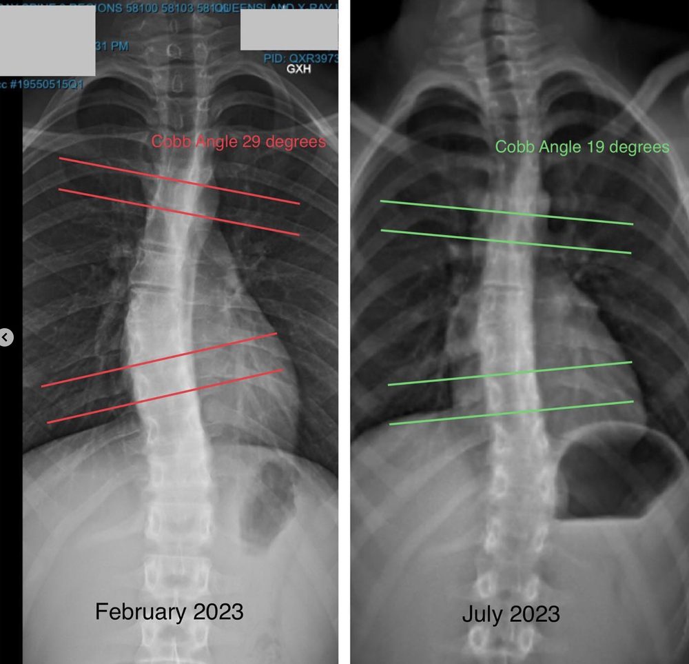 how to fix scoliosis in children — Functional Patterns Brisbane