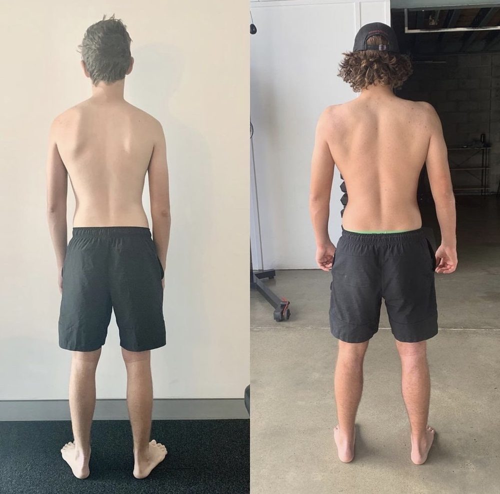 CASE STUDY OF WINGED SCAPULA Correction — Functional Patterns Brisbane